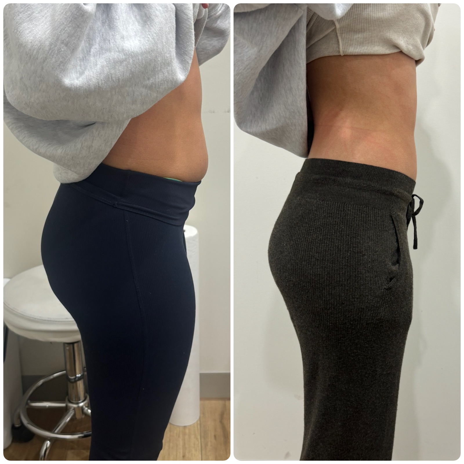 Trilipo result on Waistline