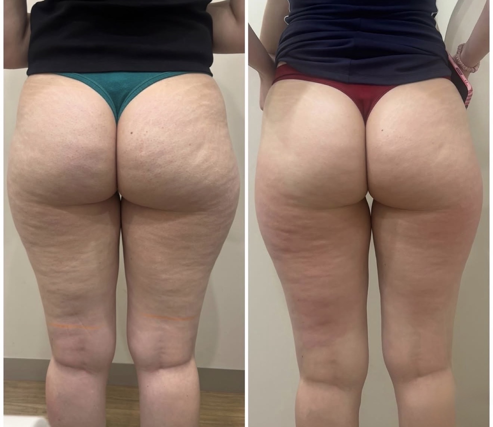 Trilipo result on Glutes & Thighs